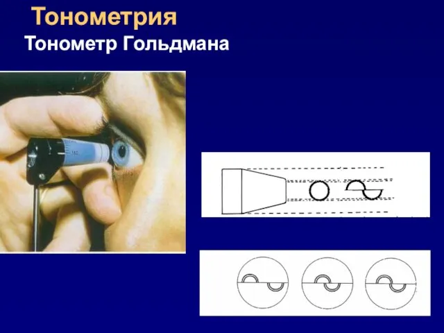 Тонометрия Тонометр Гольдмана