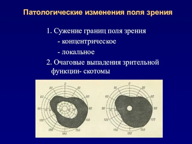 Патологические изменения поля зрения 1. Сужение границ поля зрения -