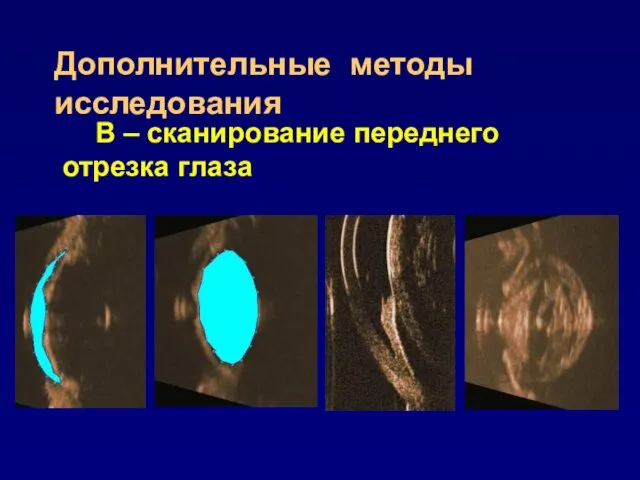 Дополнительные методы исследования В – сканирование переднего отрезка глаза