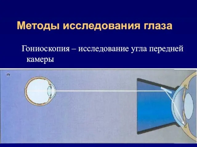 Методы исследования глаза Гониоскопия – исследование угла передней камеры