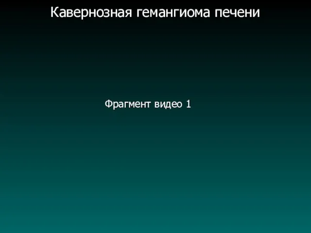 Кавернозная гемангиома печени Фрагмент видео 1