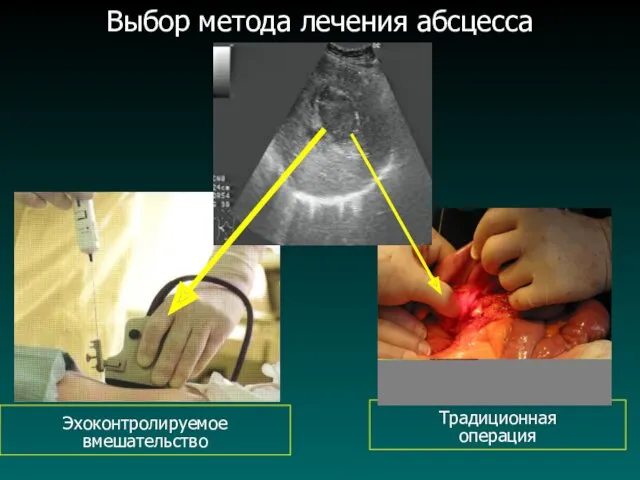 Выбор метода лечения абсцесса Традиционная операция Эхоконтролируемое вмешательство