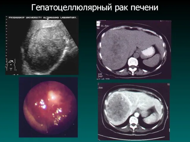 Гепатоцеллюлярный рак печени