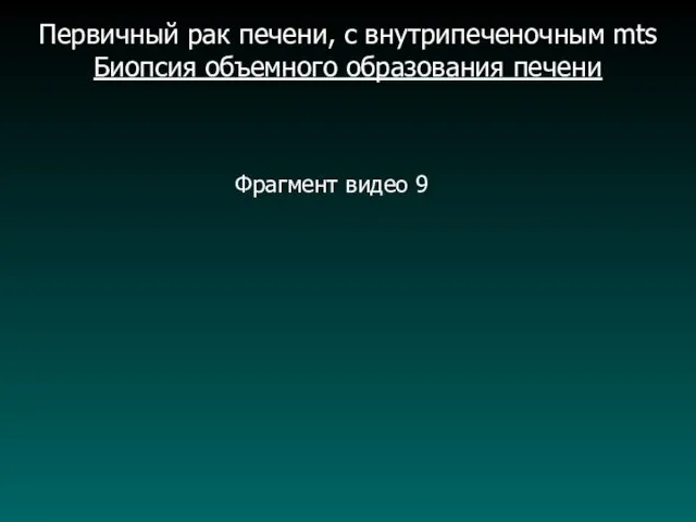 Первичный рак печени, с внутрипеченочным mts Биопсия объемного образования печени Фрагмент видео 9