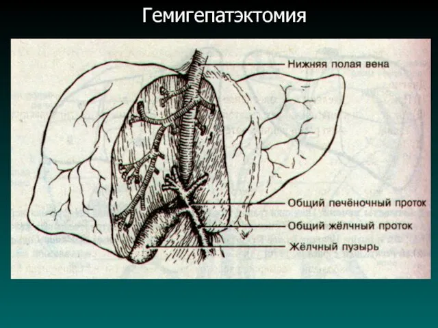 Гемигепатэктомия