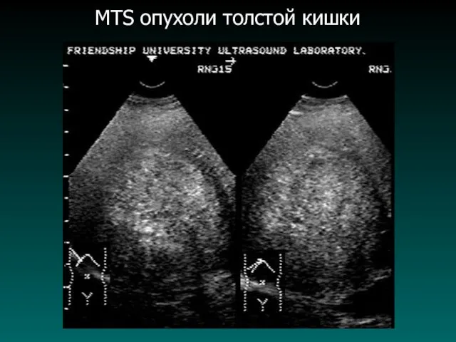 MTS опухоли толстой кишки