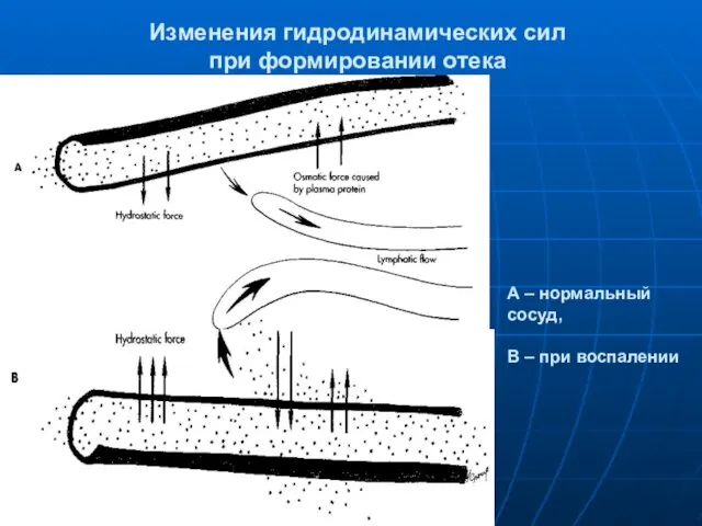 Изменения гидродинамических сил при формировании отека А – нормальный сосуд, В – при воспалении