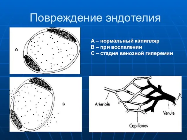 Повреждение эндотелия A – нормальный капилляр В – при воспалении С – стадия венозной гиперемии