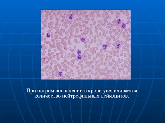 При остром воспалении в крови увеличивается количество нейтрофильных лейкоцитов.