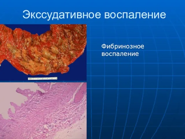 Экссудативное воспаление Фибринозное воспаление