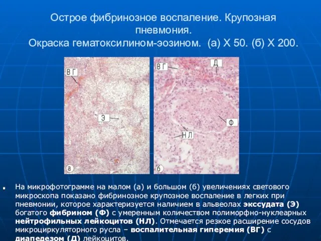 Острое фибринозное воспаление. Крупозная пневмония. Окраска гематоксилином-эозином. (а) Х 50.