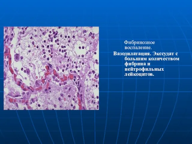 Фибринозное воспаление. Вазодилатация. Экссудат с большим количеством фибрина и нейтрофильных лейкоцитов.