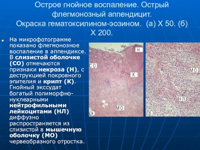 Острое гнойное воспаление. Острый флегмонозный аппендицит. Окраска гематоксилином-эозином. (а) Х