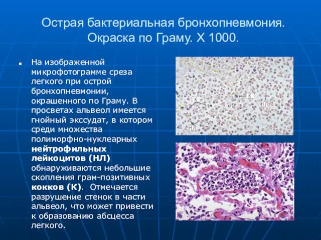 Острая бактериальная бронхопневмония. Окраска по Граму. Х 1000. На изображенной