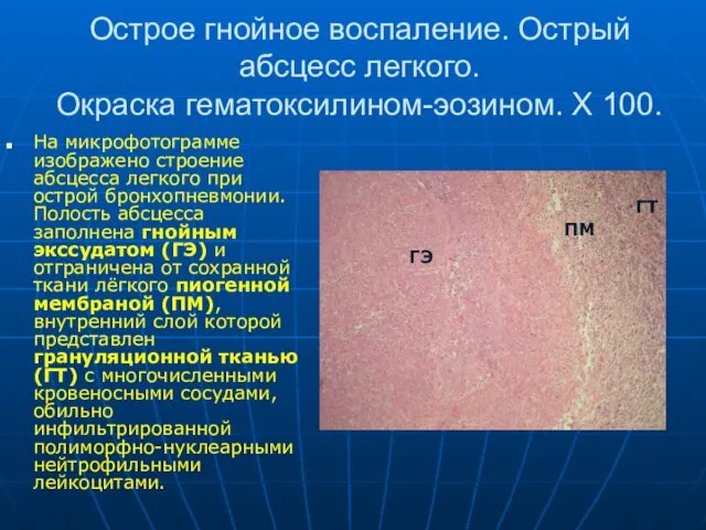 Острое гнойное воспаление. Острый абсцесс легкого. Окраска гематоксилином-эозином. Х 100.