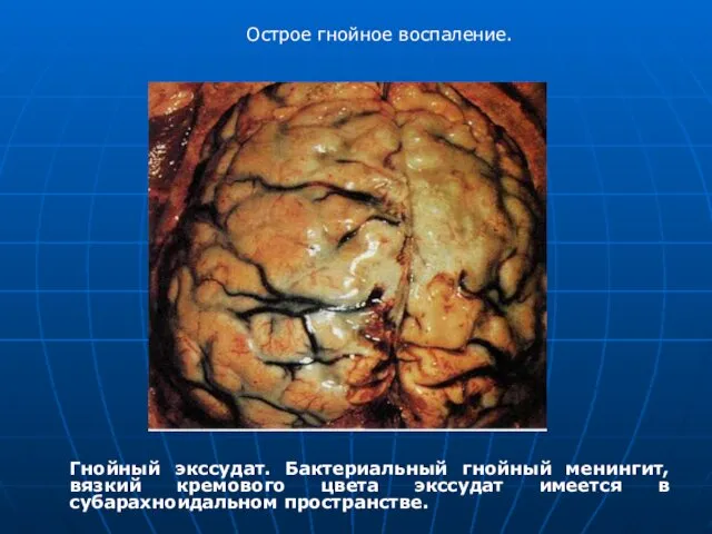 Гнойный экссудат. Бактериальный гнойный менингит, вязкий кремового цвета экссудат имеется в субарахноидальном пространстве. Острое гнойное воспаление.