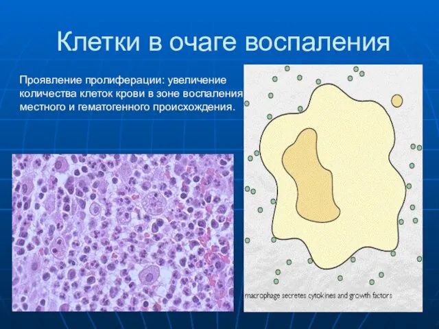 Клетки в очаге воспаления Проявление пролиферации: увеличение количества клеток крови