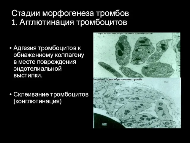 Стадии морфогенеза тромбов 1. Агглютинация тромбоцитов Адгезия тромбоцитов к обнаженному