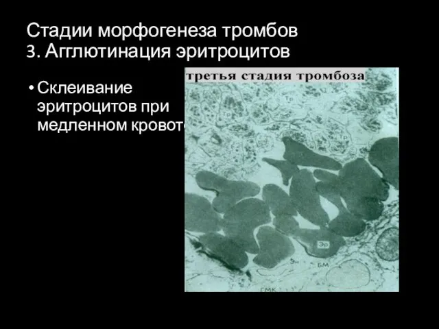 Стадии морфогенеза тромбов 3. Агглютинация эритроцитов Склеивание эритроцитов при медленном кровотоке