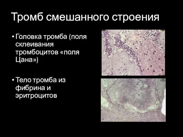 Тромб смешанного строения Головка тромба (поля склеивания тромбоцитов «поля Цана») Тело тромба из фибрина и эритроцитов