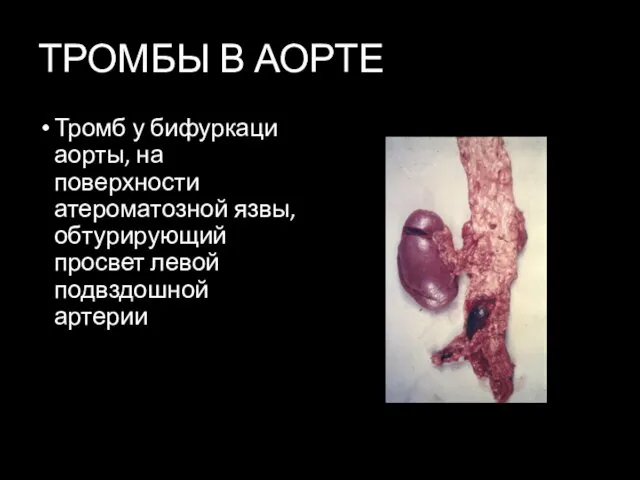 ТРОМБЫ В АОРТЕ Тромб у бифуркаци аорты, на поверхности атероматозной язвы, обтурирующий просвет левой подвздошной артерии