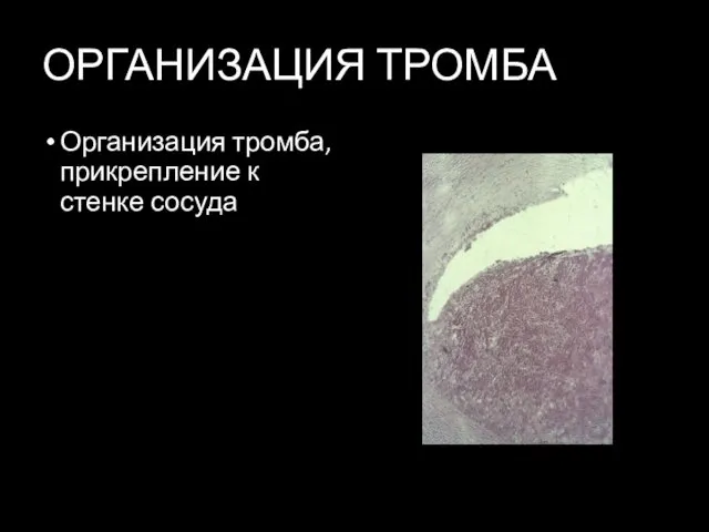 ОРГАНИЗАЦИЯ ТРОМБА Организация тромба, прикрепление к стенке сосуда