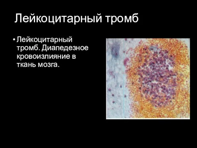 Лейкоцитарный тромб Лейкоцитарный тромб. Диапедезное кровоизлияние в ткань мозга.