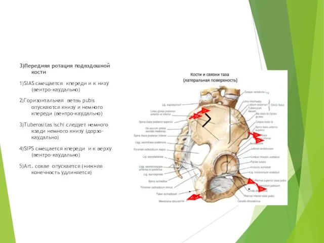 3)Передняя ротация подвздошной кости 1)SIAS смещается кпереди и к низу