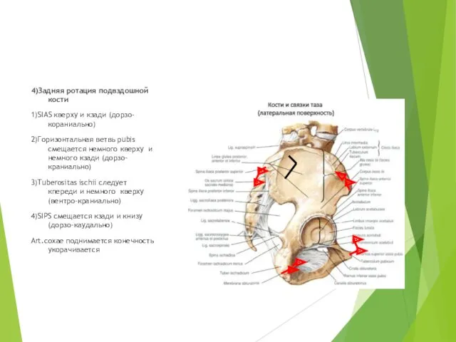 4)Задняя ротация подвздошной кости 1)SIAS кверху и кзади (дорзо-кораниально) 2)Горизонтальная