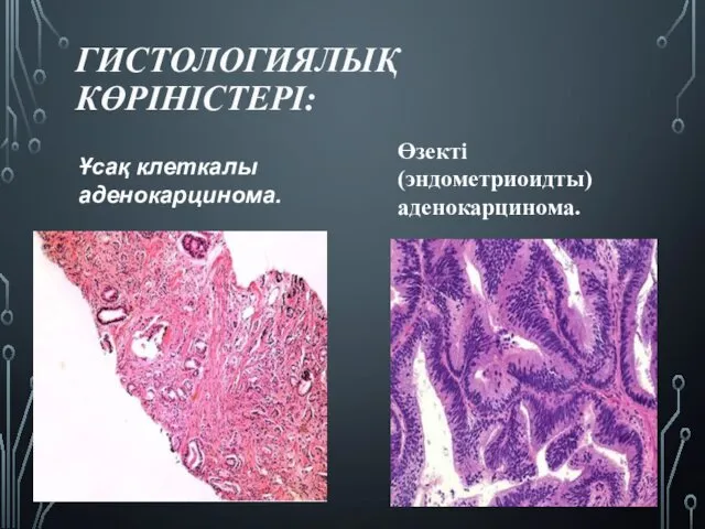 ГИСТОЛОГИЯЛЫҚ КӨРІНІСТЕРІ: Ұсақ клеткалы аденокарцинома. Өзекті (эндометриоидты) аденокарцинома.