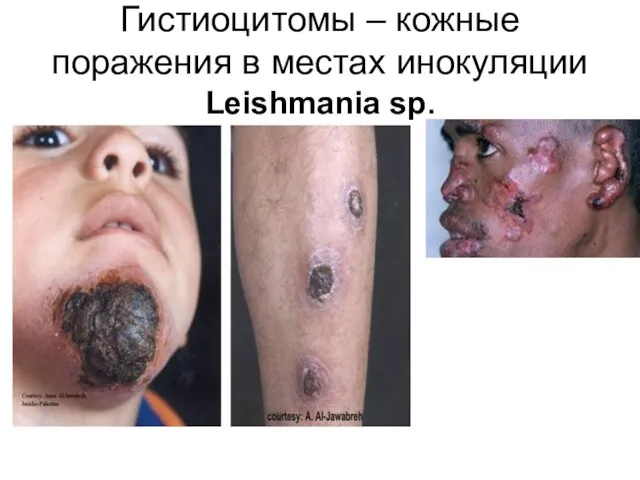Гистиоцитомы – кожные поражения в местах инокуляции Leishmania sp.