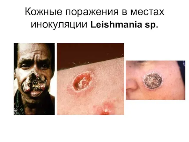 Кожные поражения в местах инокуляции Leishmania sp.