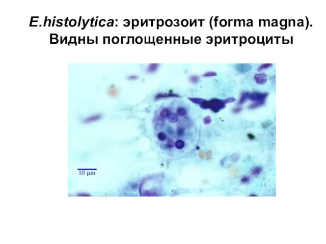 E.histolytica: эритрозоит (forma magna). Видны поглощенные эритроциты