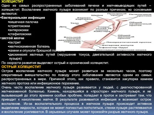 ХОЛЕЦИСТИТ Одно из самых распространенных заболеваний печени и желчевыводящих путей – холецистит. Воспаление