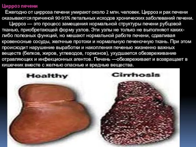 Цирроз печени Ежегодно от цирроза печени умирают около 2 млн. человек. Цирроз и