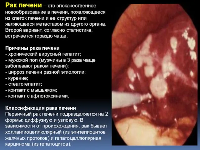 Рак печени – это злокачественное новообразование в печени, появляющееся из