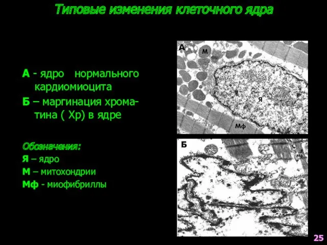 Типовые изменения клеточного ядра А - ядро нормального кардиомиоцита Б – маргинация хрома-тина