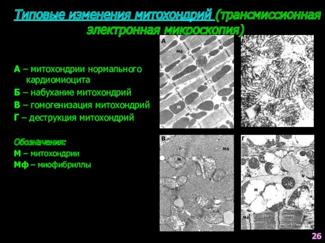 Типовые изменения митохондрий (трансмиссионная электронная микроскопия) А – митохондрии нормального кардиомиоцита Б –