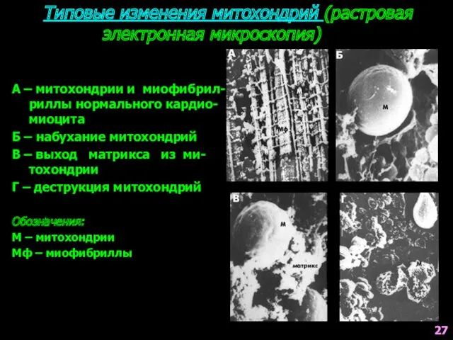 Типовые изменения митохондрий (растровая электронная микроскопия) А – митохондрии и миофибрил-риллы нормального кардио-миоцита