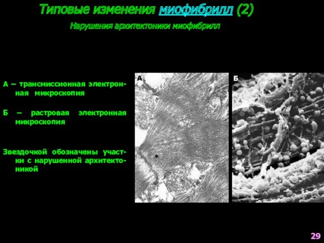 Типовые изменения миофибрилл (2) Нарушения архитектоники миофибрилл А – трансмиссионная электрон-ная микроскопия Б