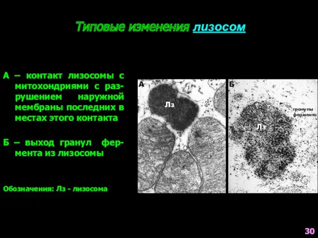 Типовые изменения лизосом А – контакт лизосомы с митохондриями с раз-рушением наружной мембраны