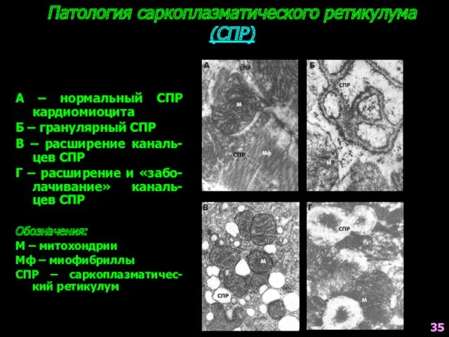 Патология саркоплазматического ретикулума (СПР) А – нормальный СПР кардиомиоцита Б – гранулярный СПР