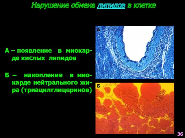 Нарушение обмена липидов в клетке А – появление в миокар-де кислых липидов Б