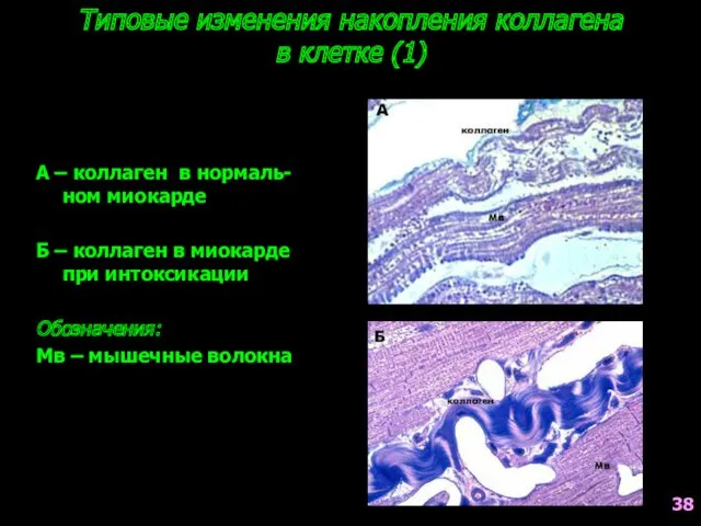 Типовые изменения накопления коллагена в клетке (1) А – коллаген в нормаль-ном миокарде