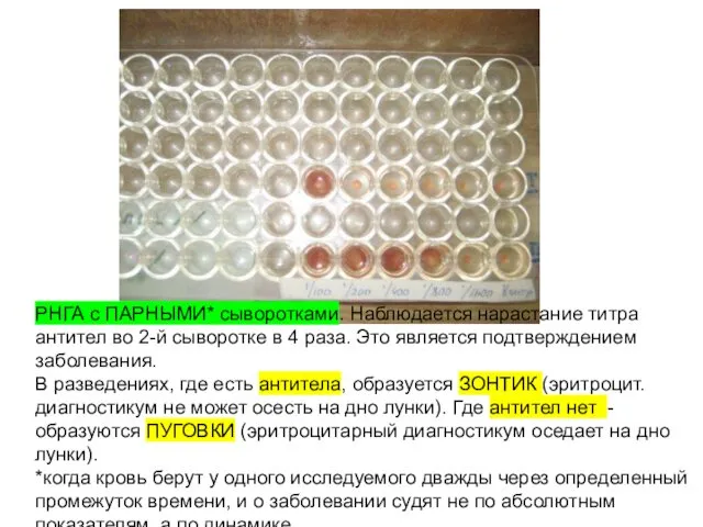 РНГА с ПАРНЫМИ* сыворотками. Наблюдается нарастание титра антител во 2-й