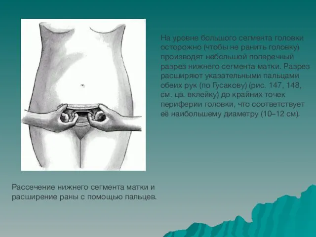 Рассечение нижнего сегмента матки и расширение раны с помощью пальцев.