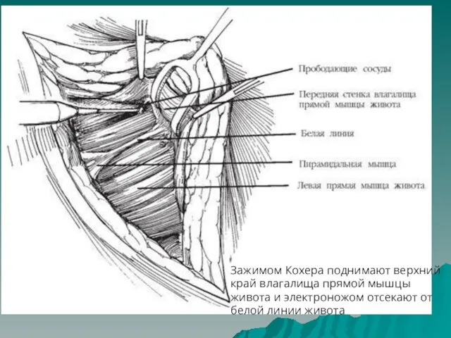 Зажимом Кохера поднимают верхний край влагалища прямой мышцы живота и электроножом отсекают от белой линии живота