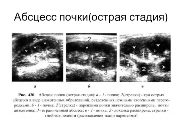 Абсцесс почки(острая стадия)