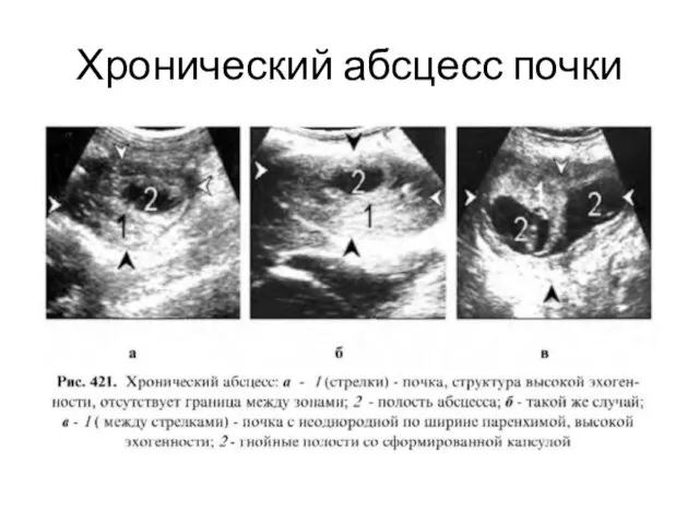 Хронический абсцесс почки