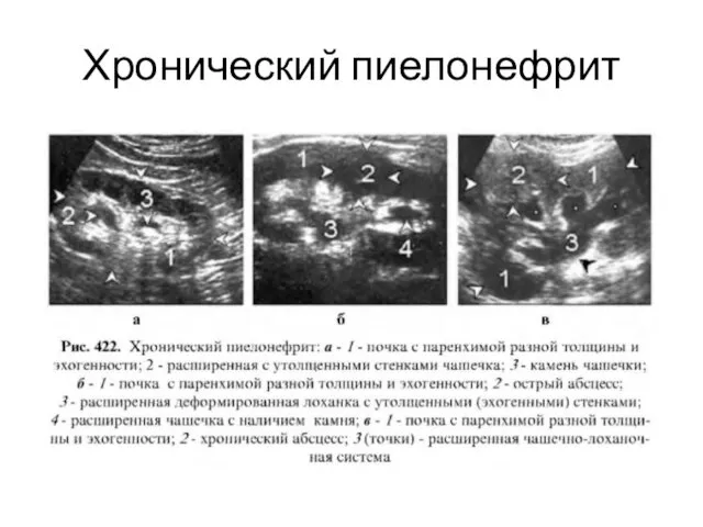 Хронический пиелонефрит